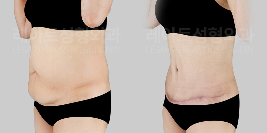 tummy-tuck-before-after(45deg)-lesarts