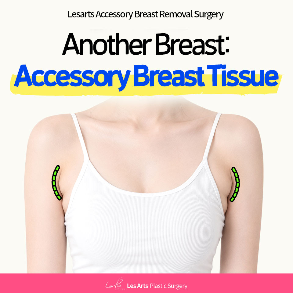 Accessory Breast Medical Column: “It’s Breast Tissue, Not Armpit Fat?” What Women Should Know Before Sleeveless Season