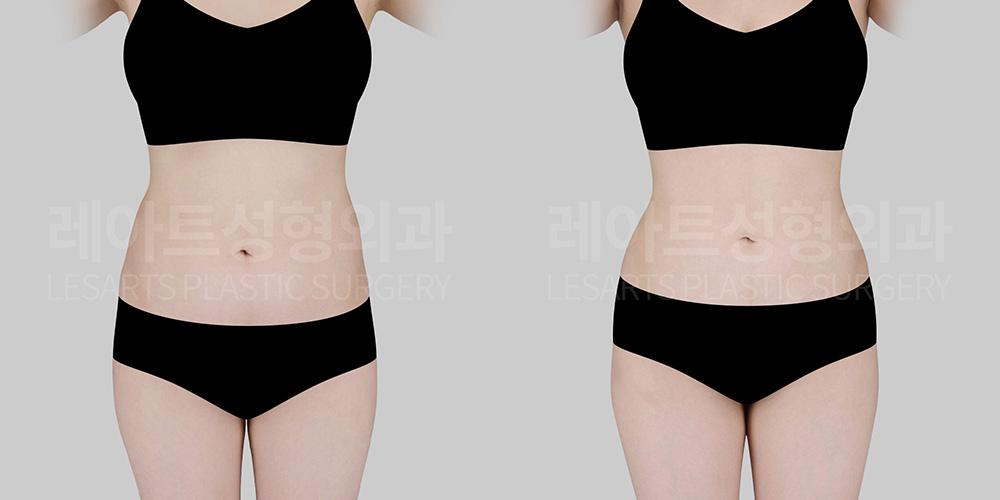 Abdominal Liposuction | Why Does Lower Belly Fat Remain Even After Dieting?