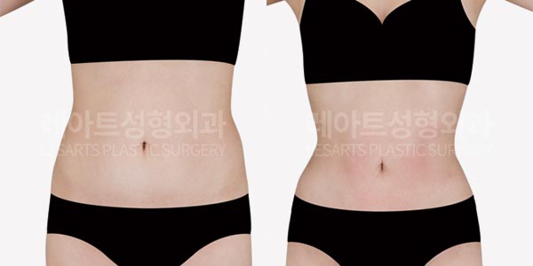 Abdominal liposuction before and after - Lesarts Plastic Surgery