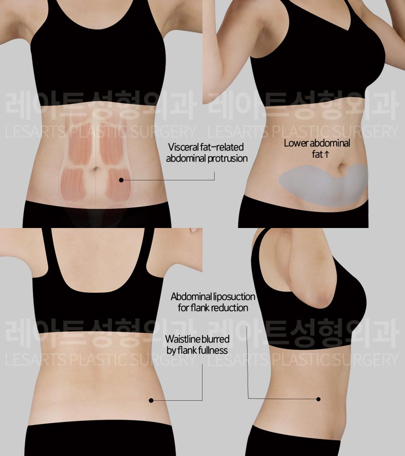 abdominal-liposuction-02-01-260728