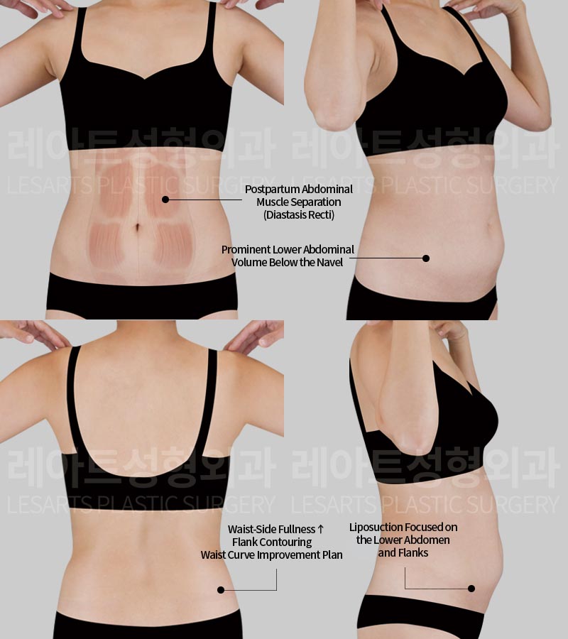 abdominal-liposuction-02-01-260811