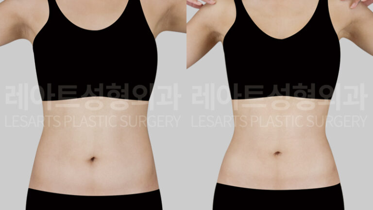 Abdominal liposuction before and after - Lesarts Plastic Surgery