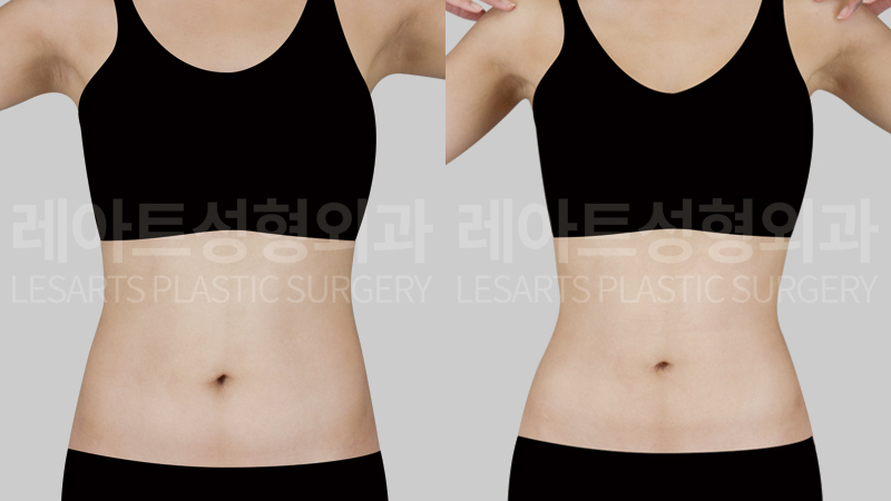 Abdominal liposuction before and after - Lesarts Plastic Surgery