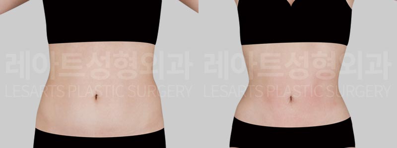 abdominal-liposuction-02-02-260811
