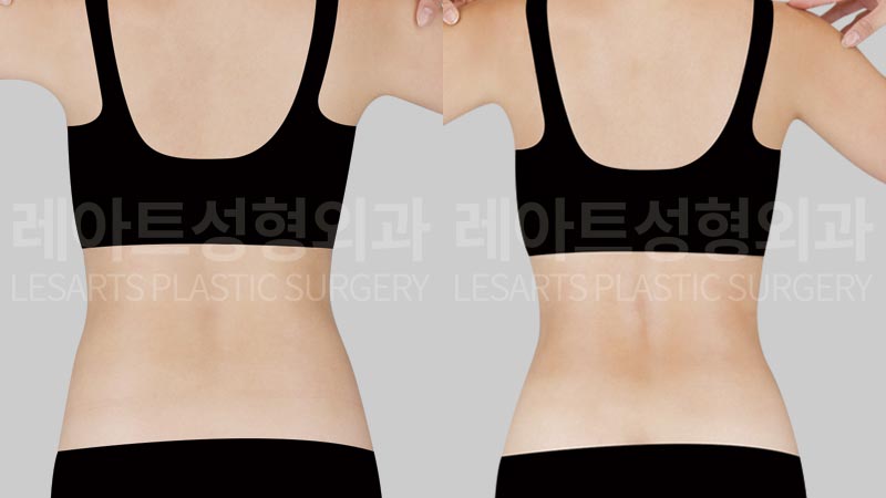 abdominal-liposuction-02-03-260728