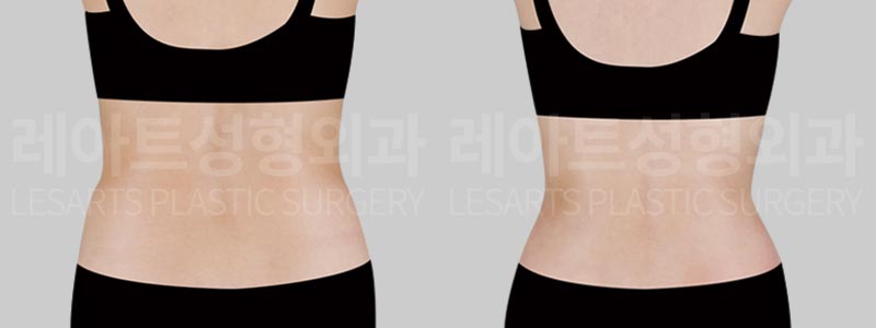 abdominal-liposuction-02-03-260811