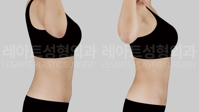 abdominal-liposuction-02-04-260728