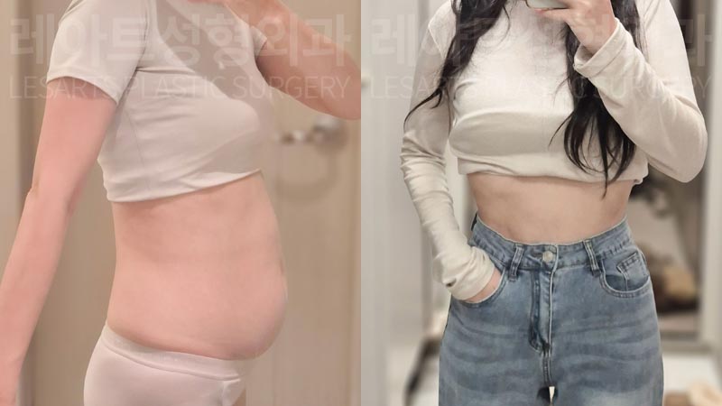 abdominal-liposuction-02-07-260811
