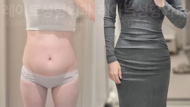abdominal-liposuction-02-08-260811