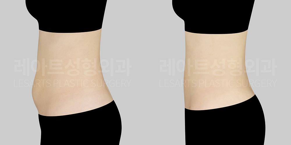 abdominal liposuction before after-lesarts plastic surgery