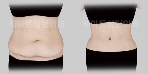abdominoplasty before and after(lesarts)
