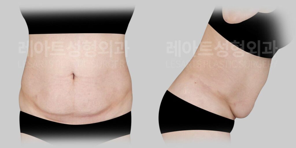 abdominoplasty-02-01-260729