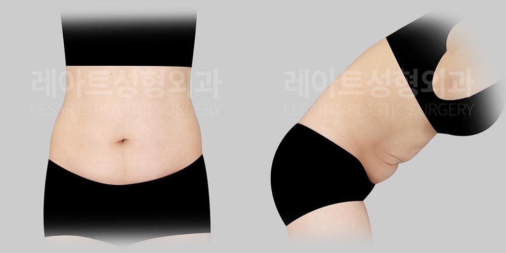 abdominoplasty-02-01-260804
