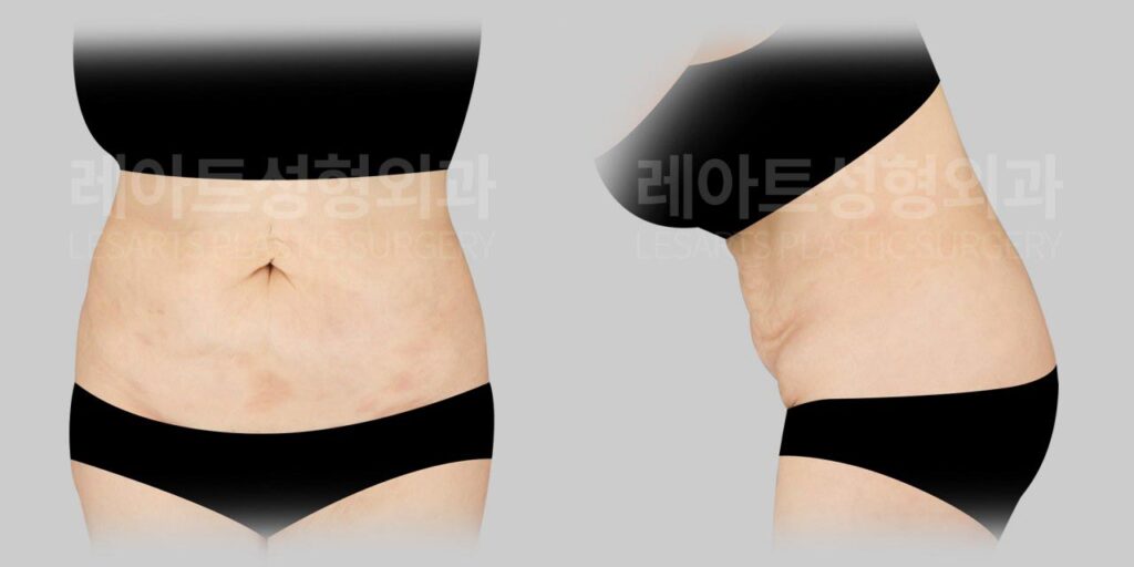 abdominoplasty-02-01-260810