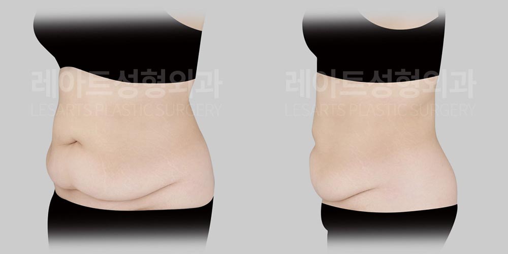 abdominoplasty-02-02-2600805