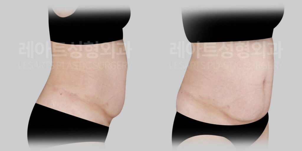 abdominoplasty-02-02-260729