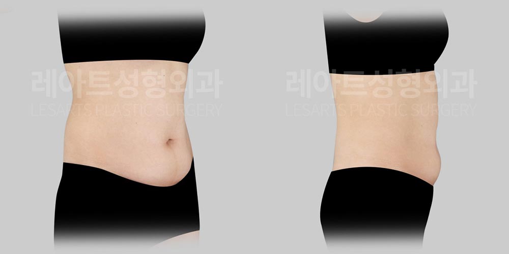 abdominoplasty-02-02-260804