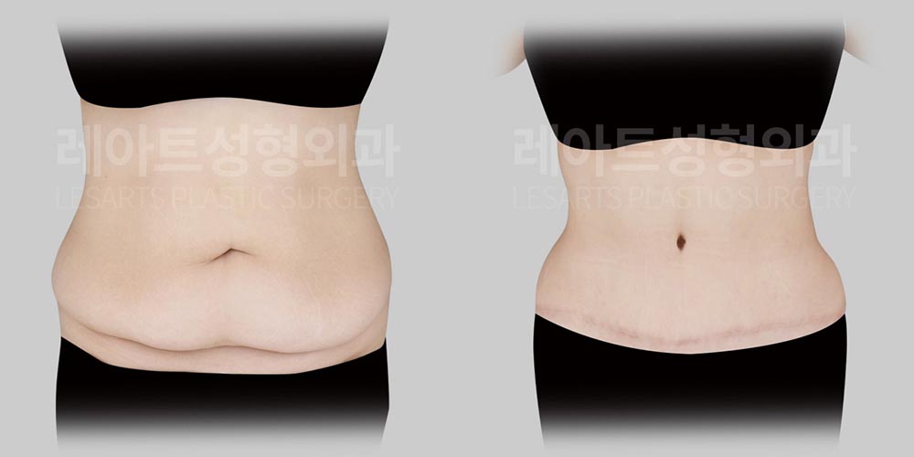 abdominoplasty-02-03-2600805
