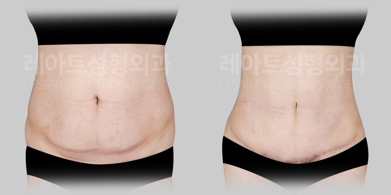abdominoplasty before and after(lesarts)