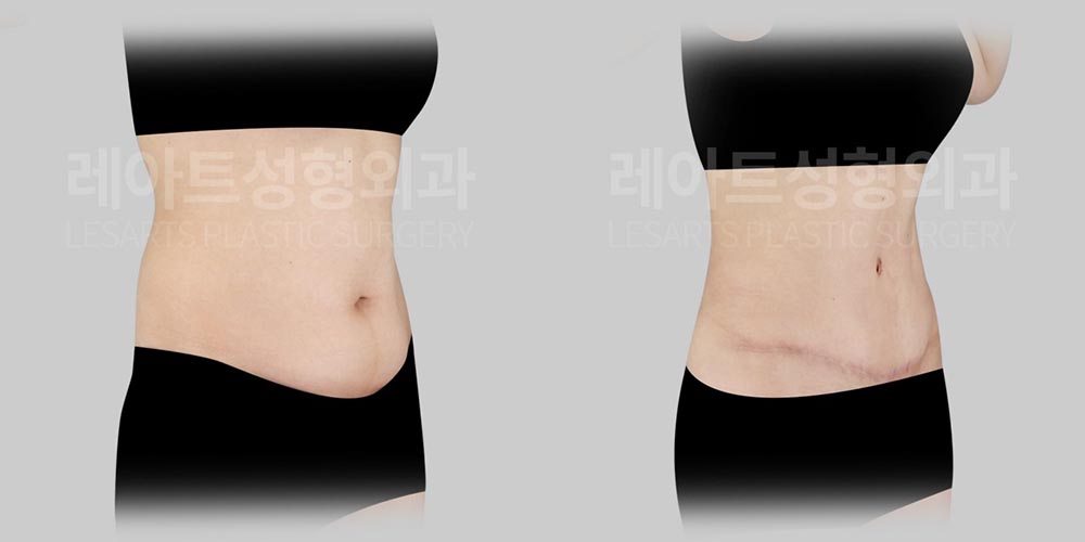 abdominoplasty before and after(lesarts)