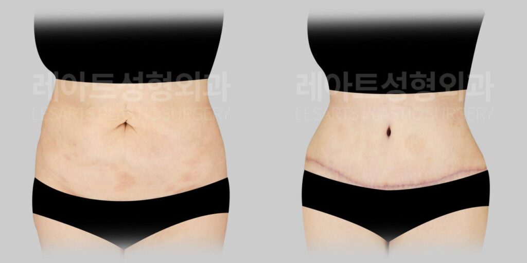 Abdominoplasty in Gangnam: 3-month results for abdominal skin sagging starting from the upper abdomen