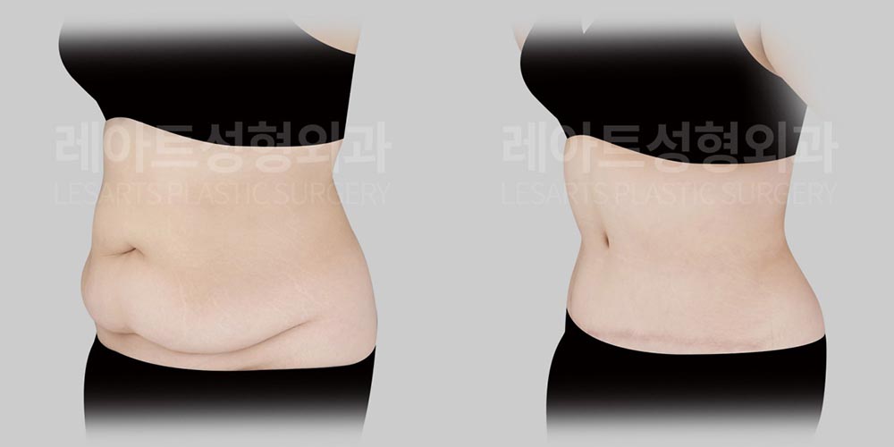 abdominoplasty-02-04-2600805