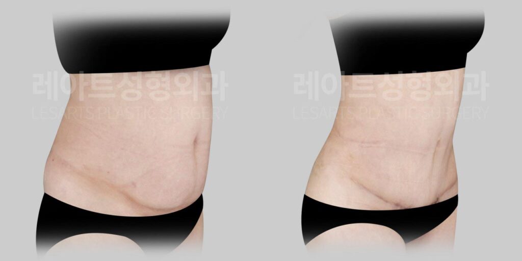abdominoplasty-02-04-260729