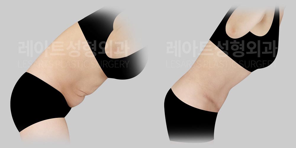 abdominoplasty-02-04-260804