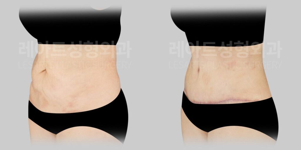abdominoplasty-02-04-260810