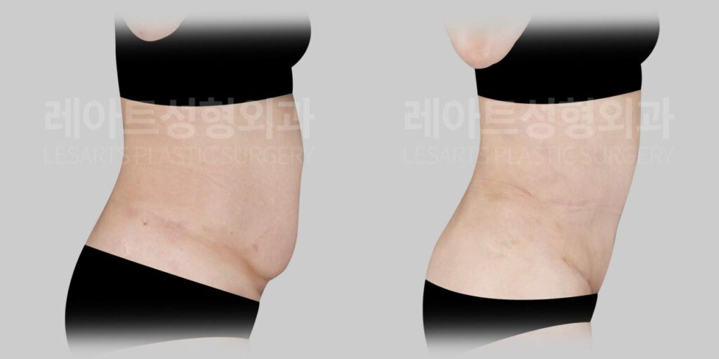 abdominoplasty-02-05-260729