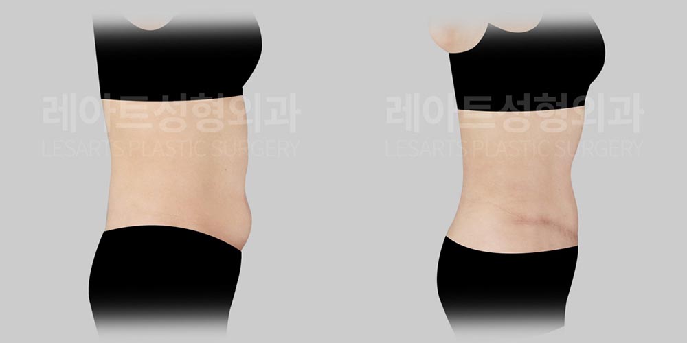 abdominoplasty-02-05-260804
