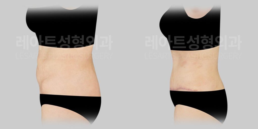 abdominoplasty-02-05-260810