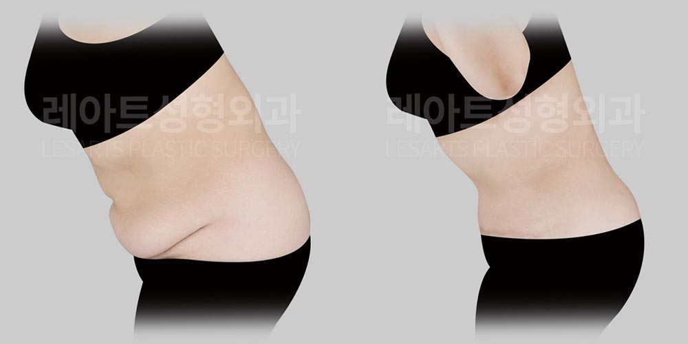 abdominoplasty-02-06-2600805