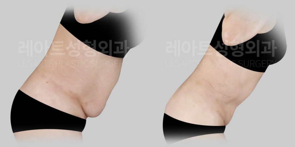 abdominoplasty-02-06-260729
