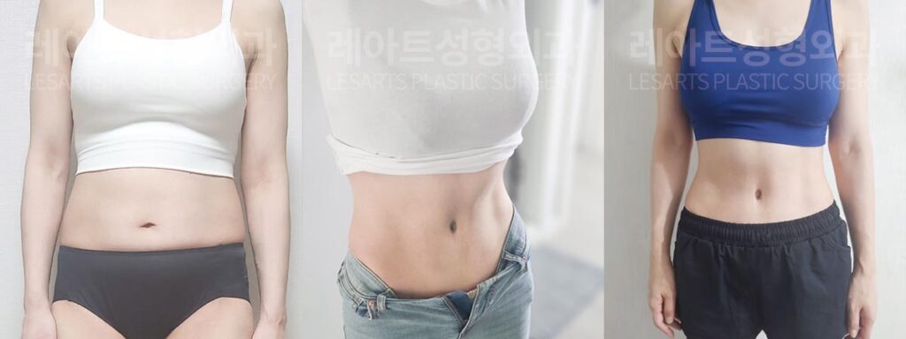 abdominoplasty-02-06-260804