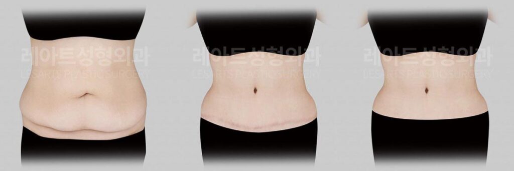 abdominoplasty-02-07-2600805