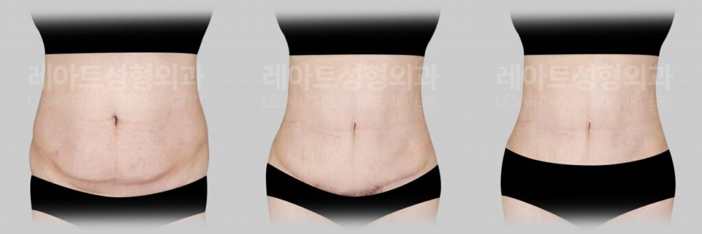 abdominoplasty-02-07-260729