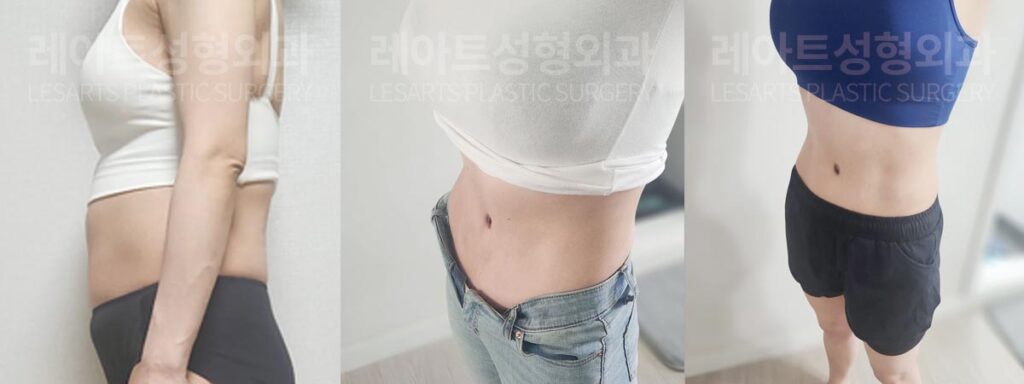 abdominoplasty-02-07-260804