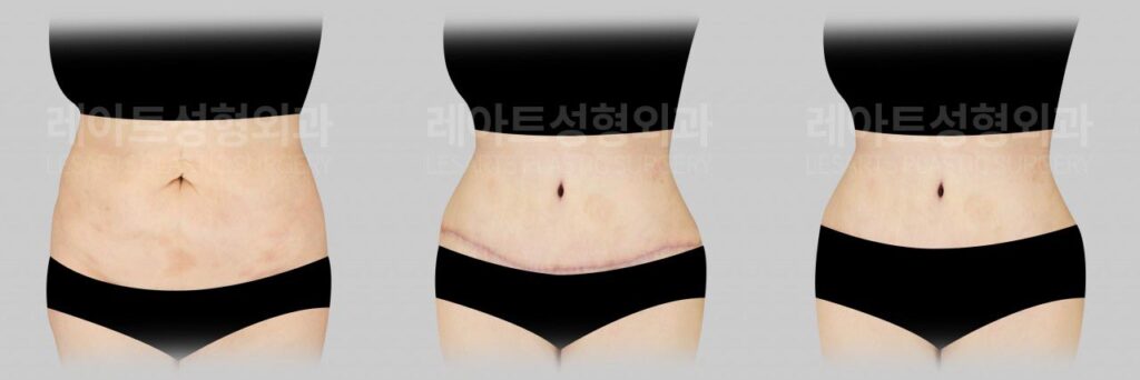 abdominoplasty-02-07-260810