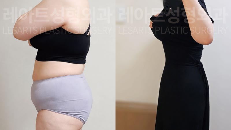 abdominoplasty-02-08-2600805
