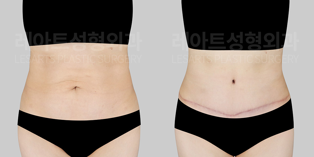 abdominoplasty before after- lesarts plastic surgery