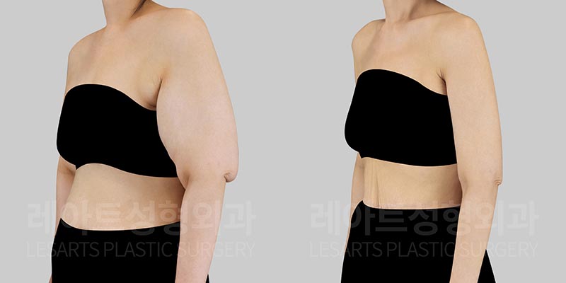 lesarts arm lift before after