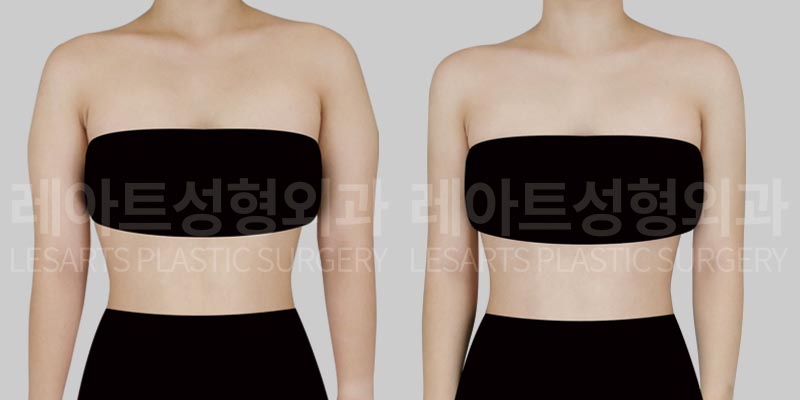arm liposuction before after - lesarts plastic surgery