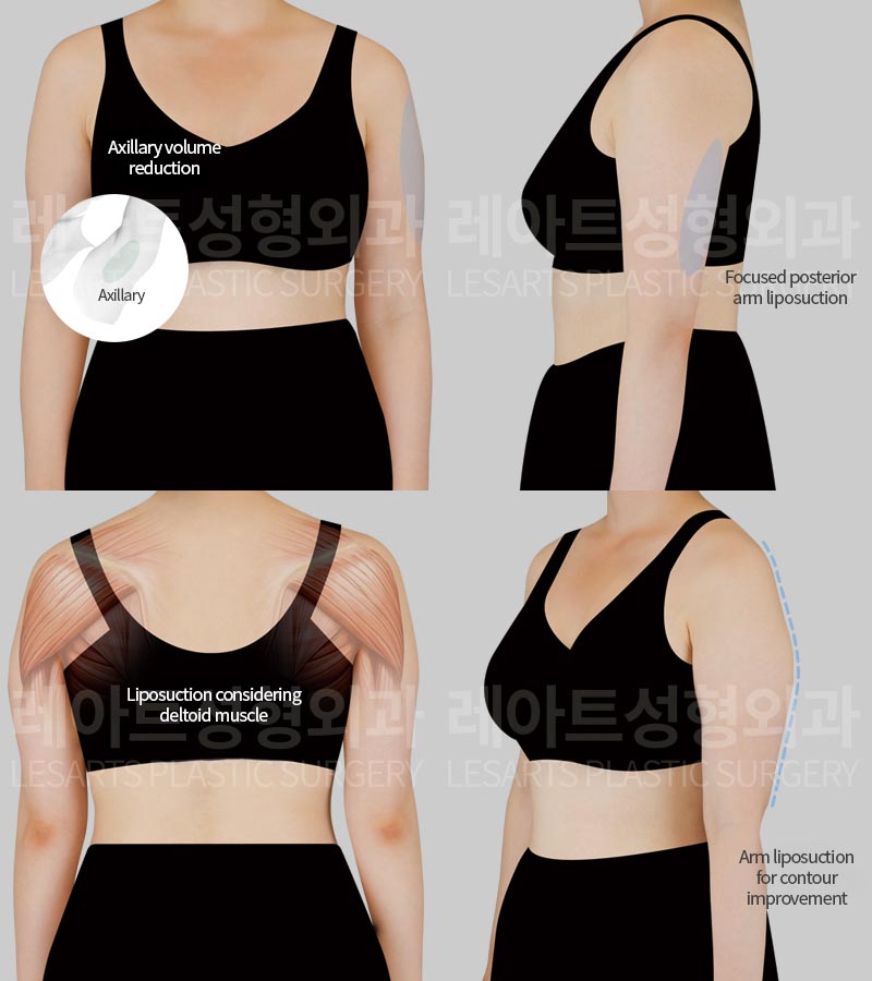 arm-liposuction-02-01-260723