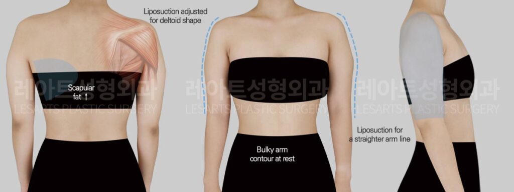 arm-liposuction-02-01-260803