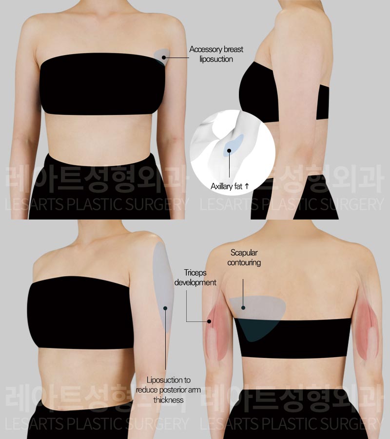 arm-liposuction-02-01-260804