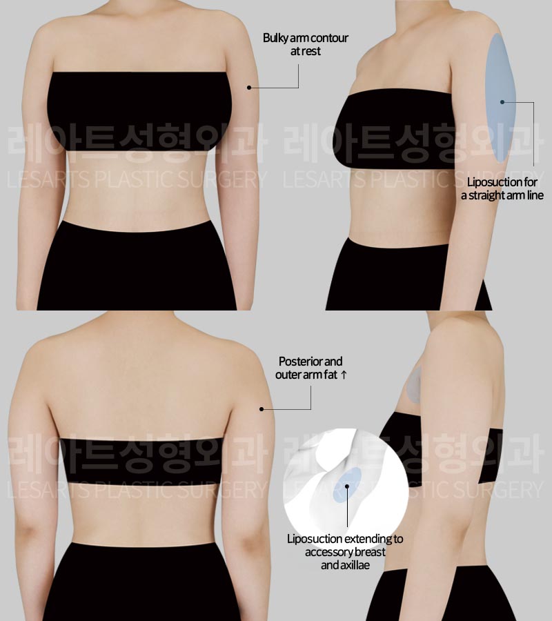 arm-liposuction-02-01-260806