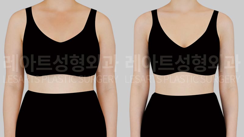 arm-liposuction-02-02-260723