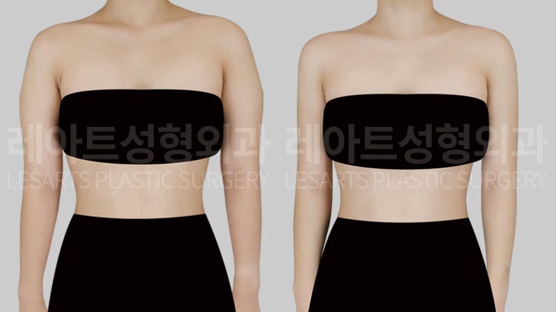 arm-liposuction-02-02-260803